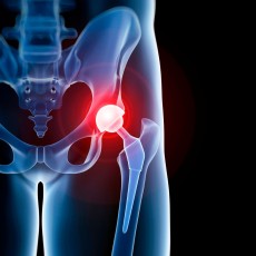 Opération de Prothèse de Hanche