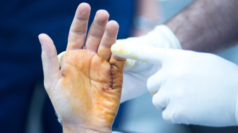 Image d'une main récemment opérée avec des points de suture