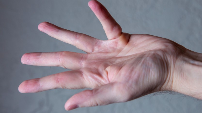 Image d'une main atteinte d'une contracture de Dupuytren