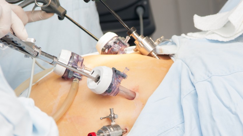 Partie de l'abdomen d'un patient opéré en salle d'opération.